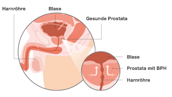 Prostata Grafik mit Beschriftungen